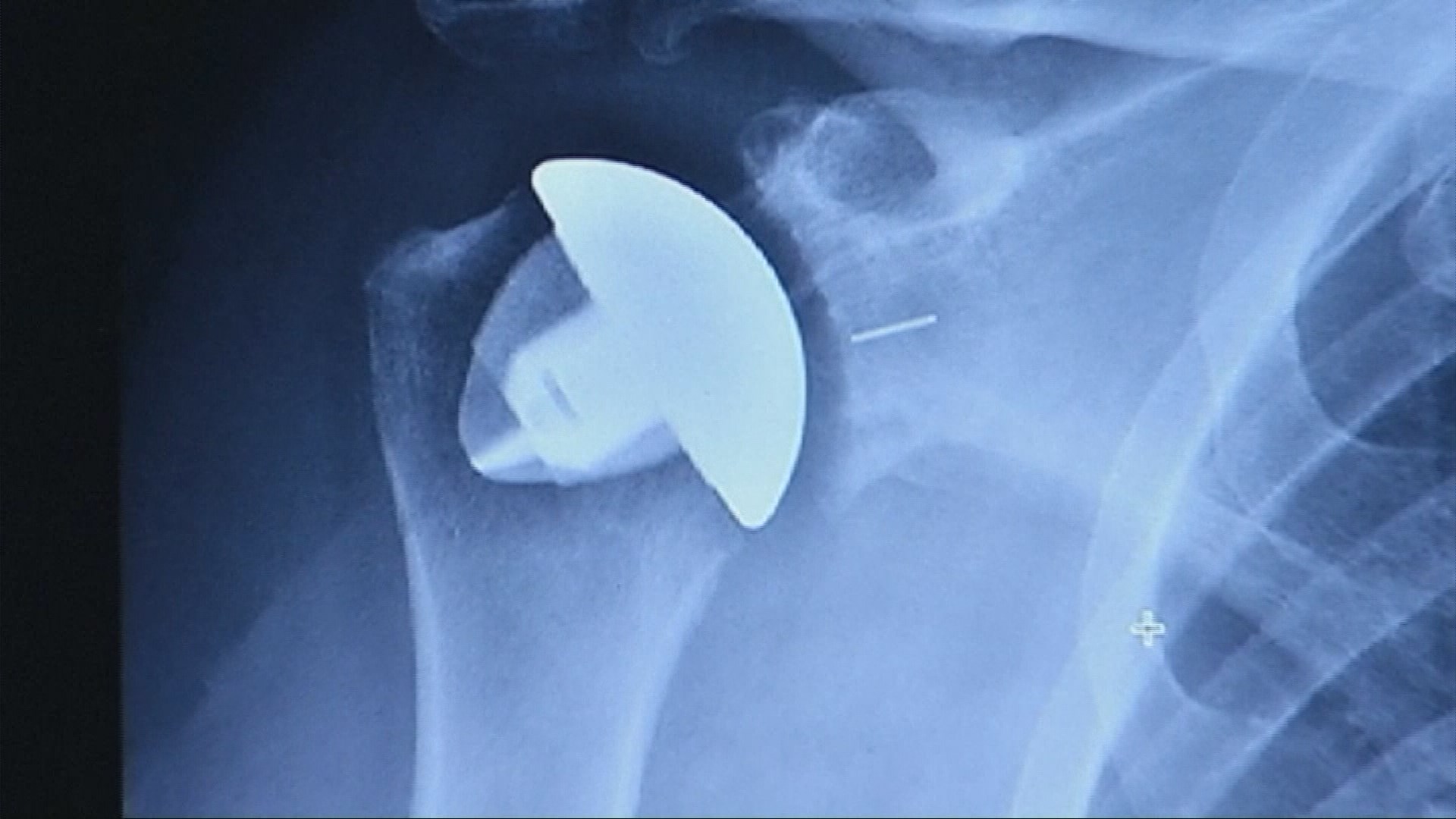New shoulder replacement techniques helps osteoarthritis